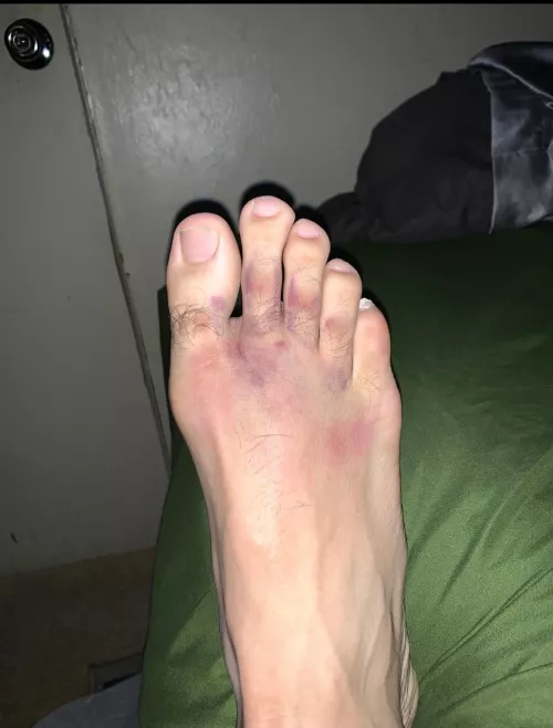 Who likes ? I got hurt