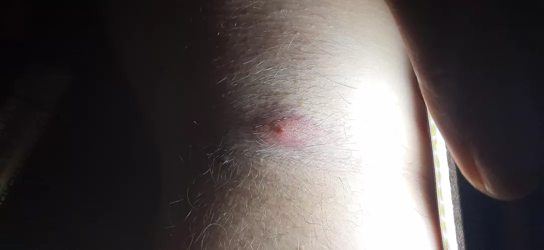 armpit pimple or swollen lymph node?