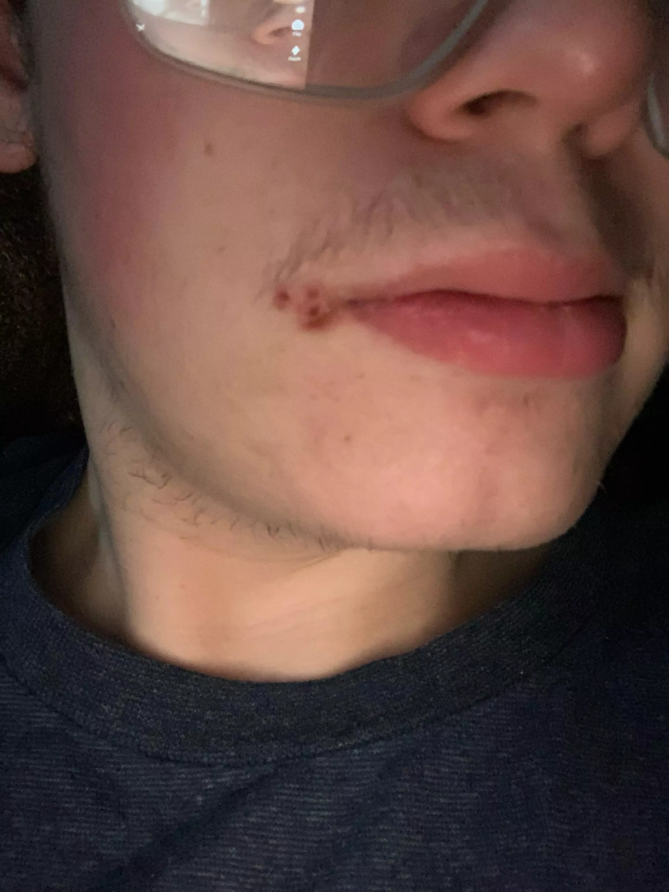 Made the mistake of popping a teeny zit in the corner of my mouth about five days ago.. total breakout and looks like I have a herpes outbreak :(
