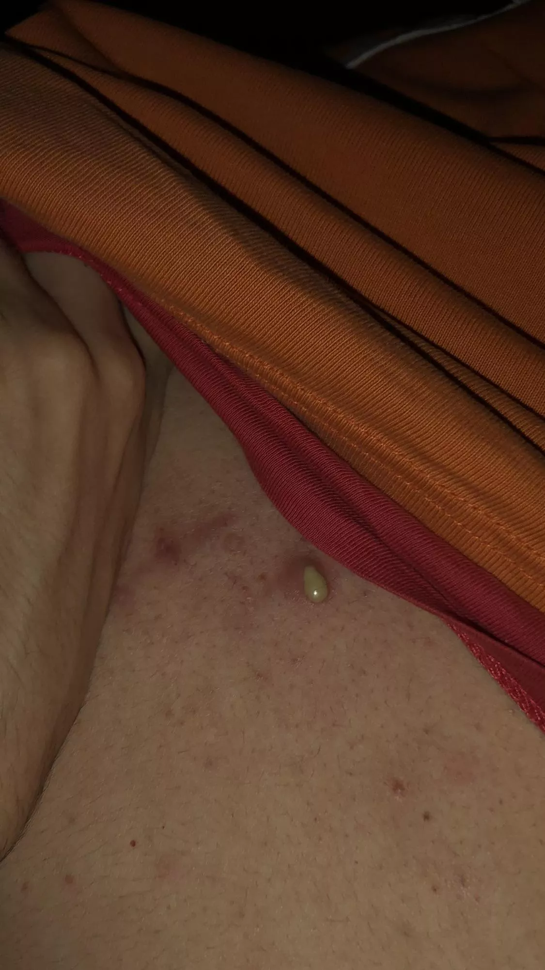 Grossest pimple as a result of my back acne…