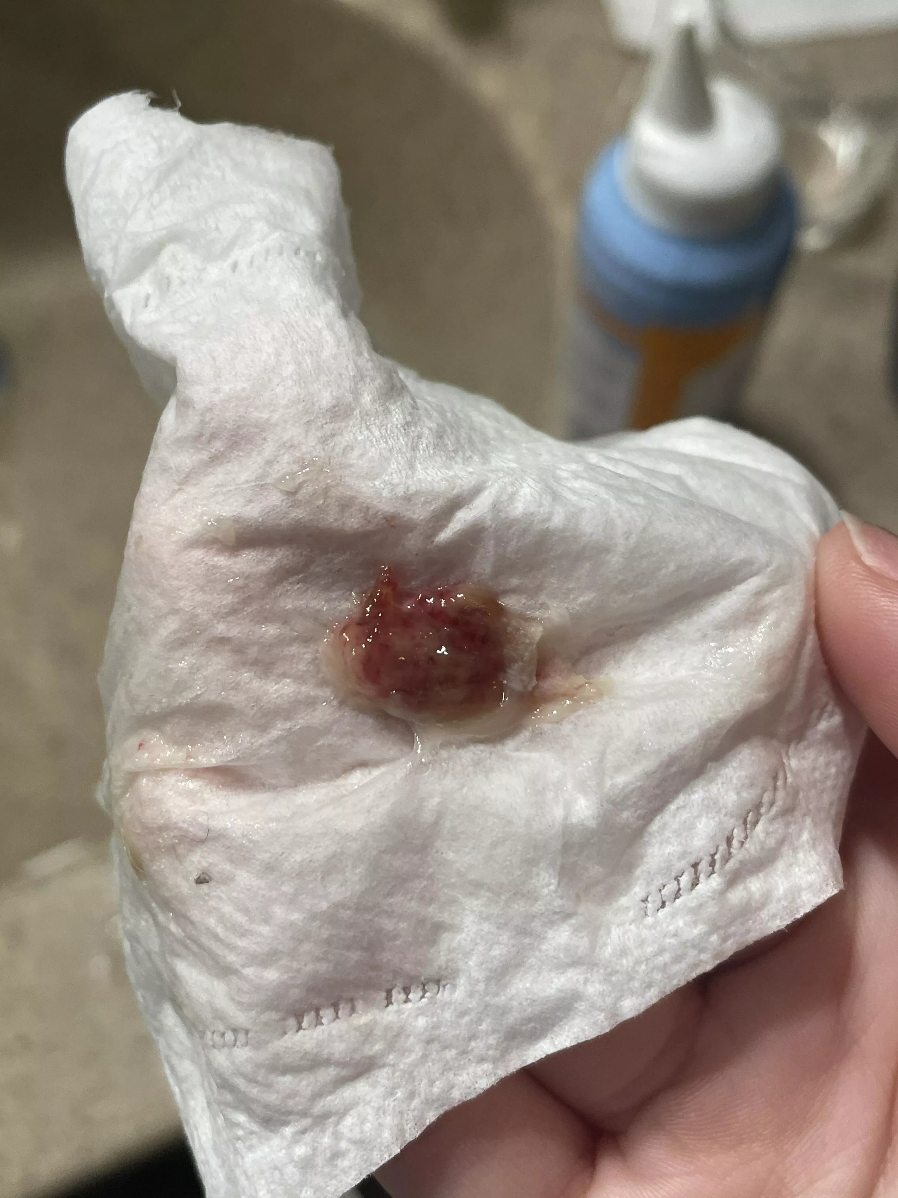 This is the second chunk of mucus that looks like this to come out of my nose today.