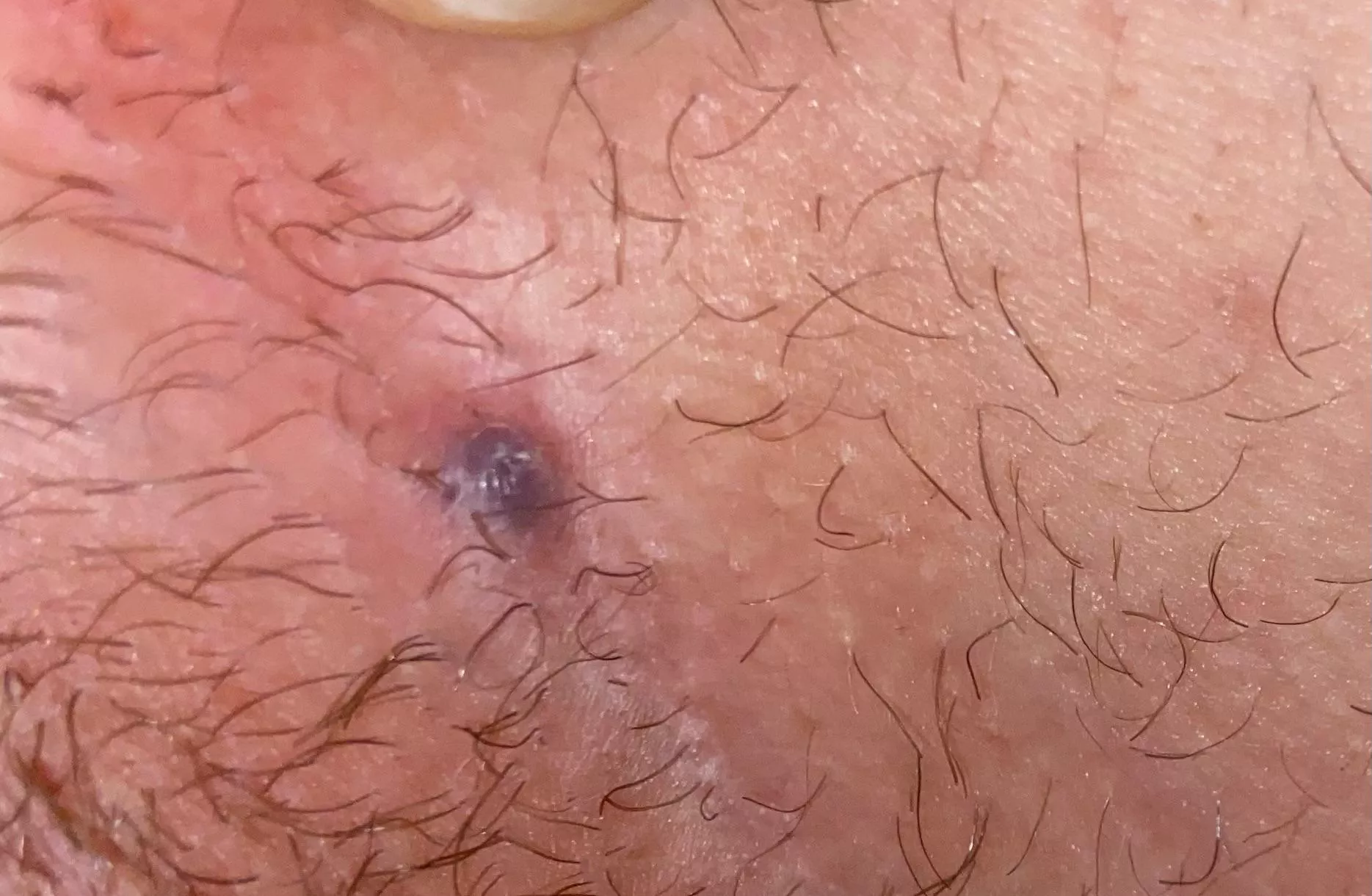 Is this an ingrown hair or a cyst? Never had anything look like this before. Between crotch and thigh
