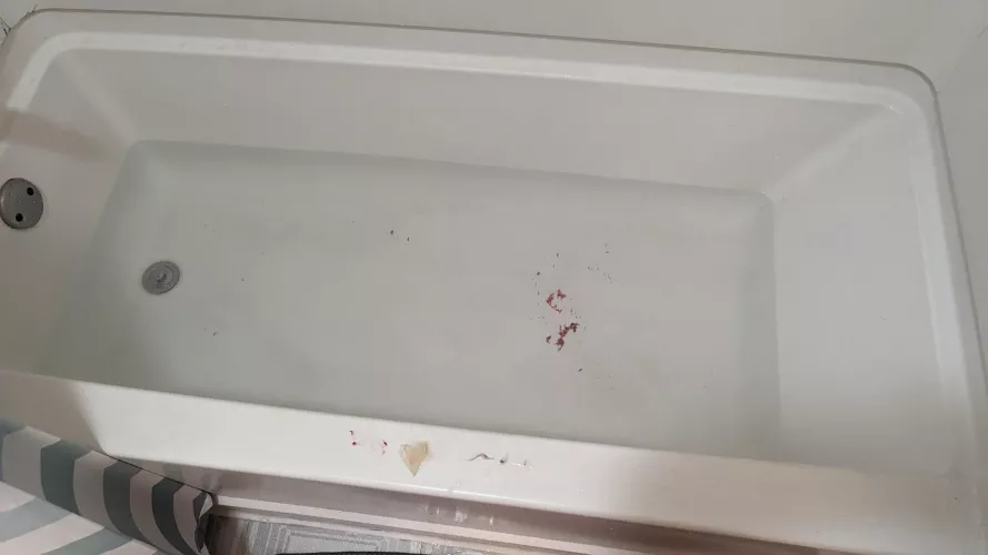 Pilonidal Cyst became infected and painful last week. Popped yesterday. This is just squeezing the crud out. Round 1 of many.