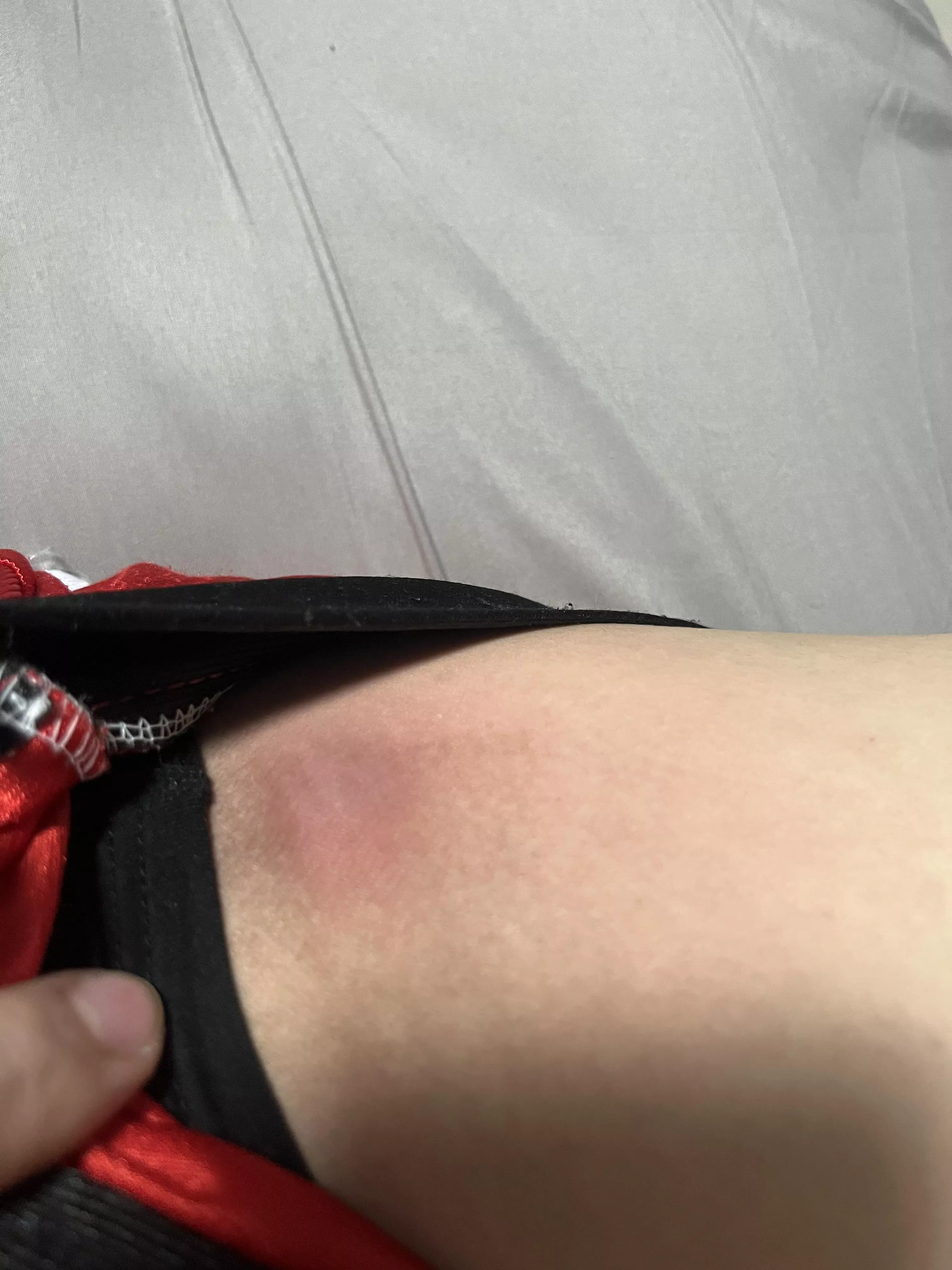 This bump on my inner thigh… anyone knows how to resolve it? No pus or anything and hurts to walk