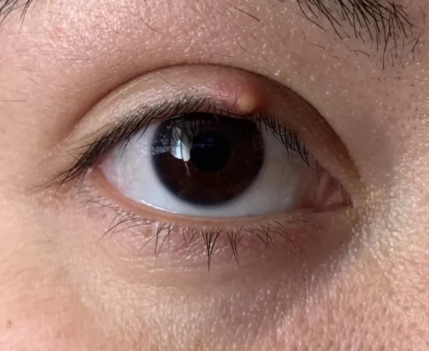 Forbidden pop… it’s so effing itchy! I’m trying warm water but nothing helps