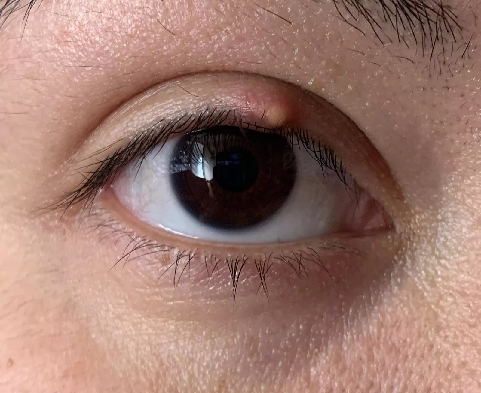 Forbidden pop… it’s so effing itchy! I’m trying warm water but nothing helps