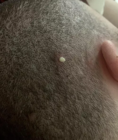 Wish I had gotten a video of this, but got this gnarly pop on my hubby’s scalp this morning. Started as a simple ingrown hair