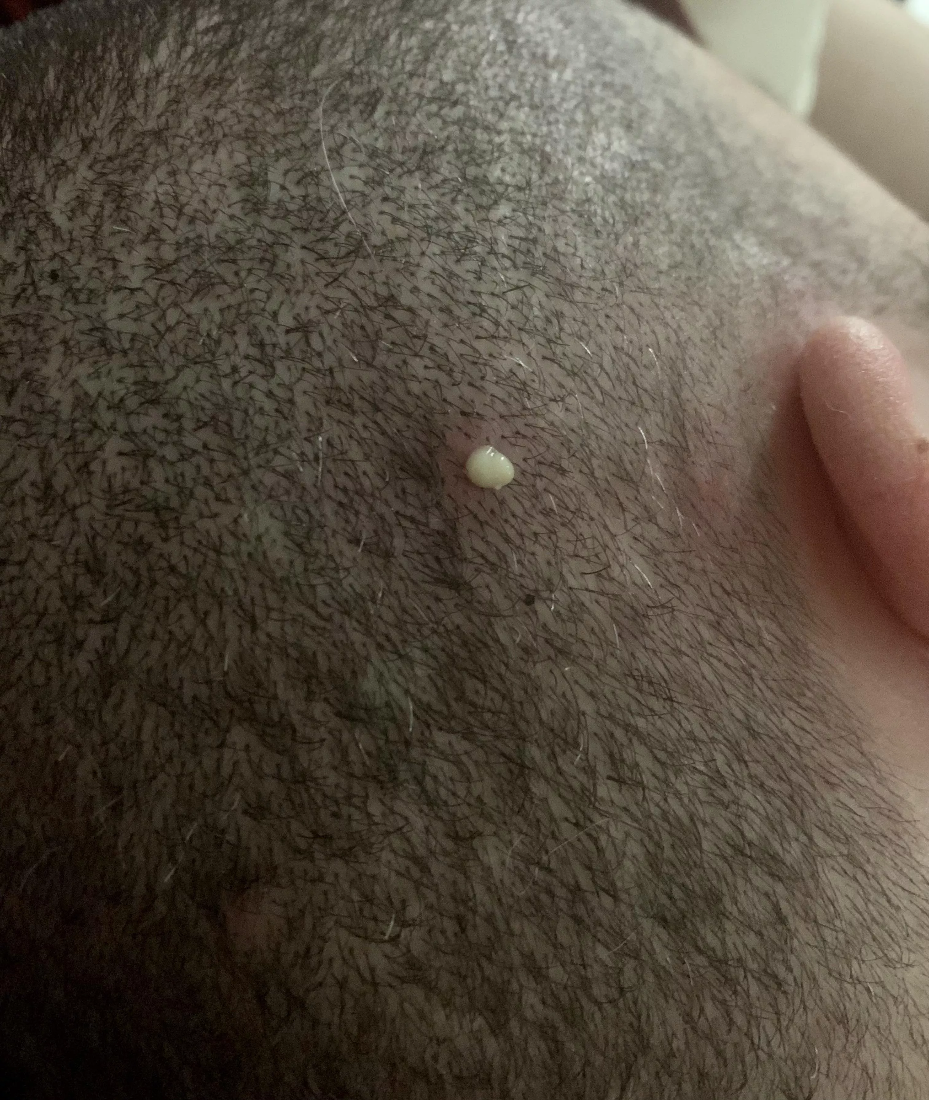 Wish I had gotten a video of this, but got this gnarly pop on my hubby’s scalp this morning. Started as a simple ingrown hair