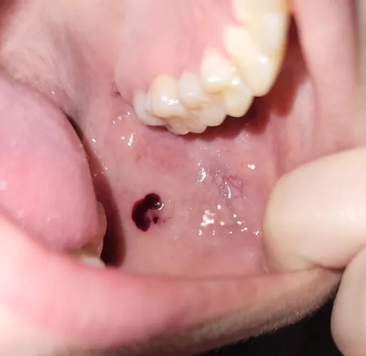 Feel bump in mouth. Look inside. Nasty blood blister 😬