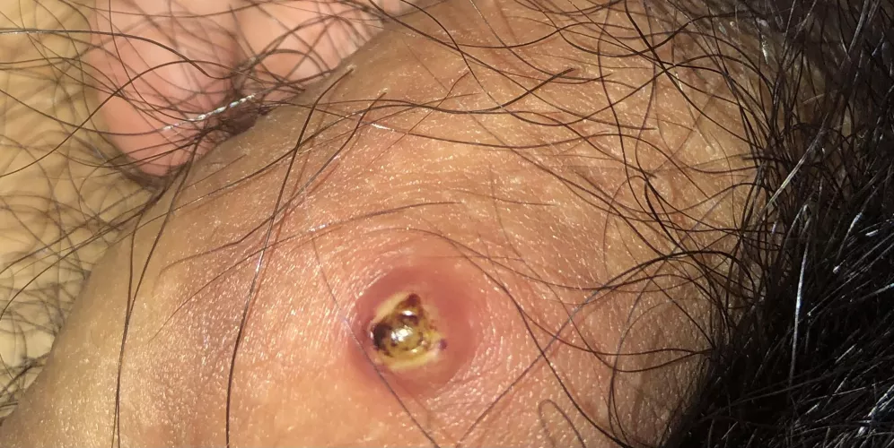 I’m scared, idk what this is in my penis, I have not been messing with it but it turnt out like this, idk what 2 do or what it is. It did not look like this yesterday or not as big.