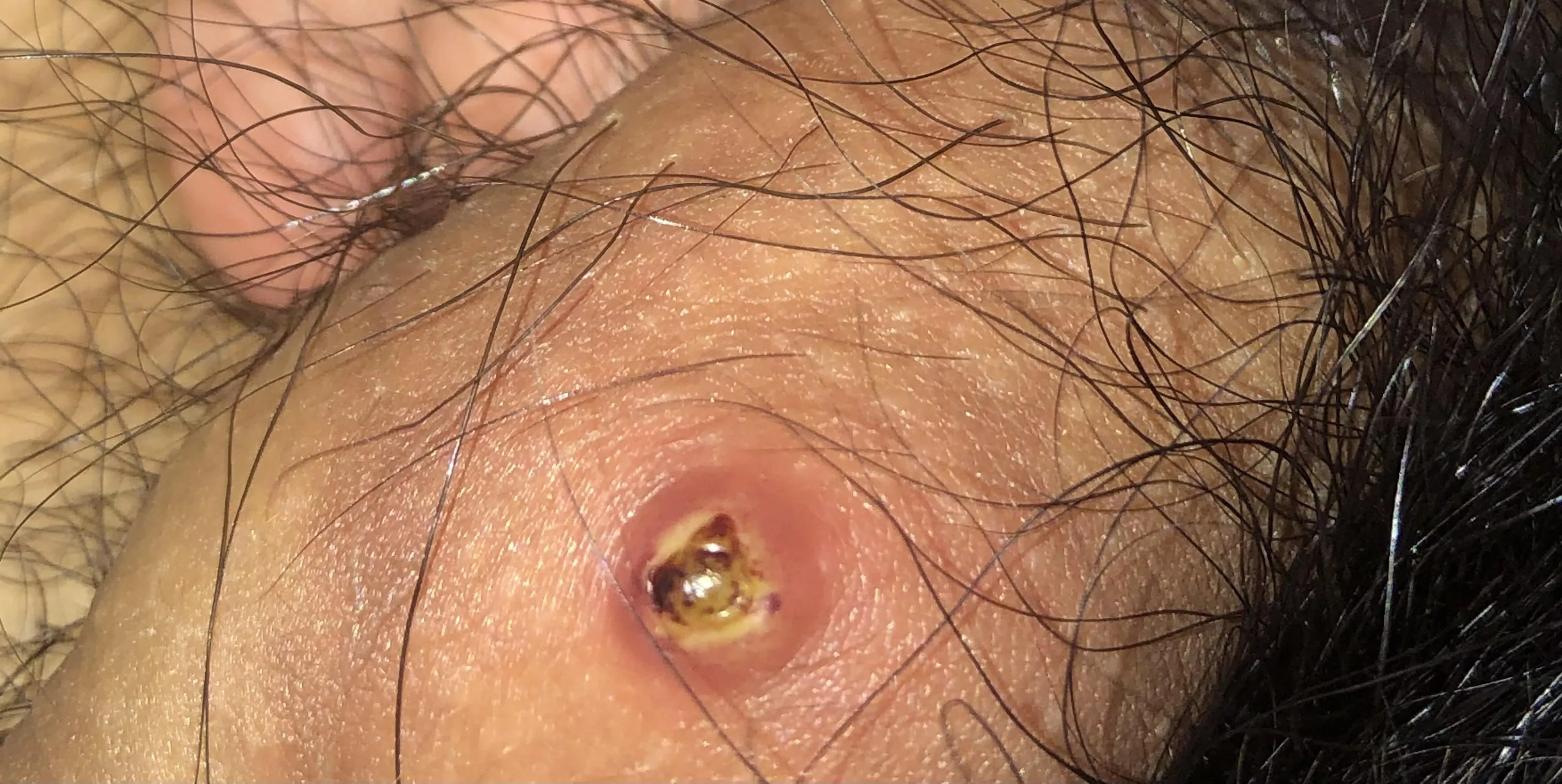 I’m scared, idk what this is in my penis, I have not been messing with it but it turnt out like this, idk what 2 do or what it is. It did not look like this yesterday or not as big. I’m scared, idk what this is in my penis, I have not been messing with it but it turnt out like this, idk what 2 do or what it is. It did not look like this yesterday or not as big.