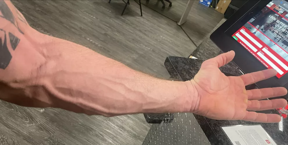 Thick Veins