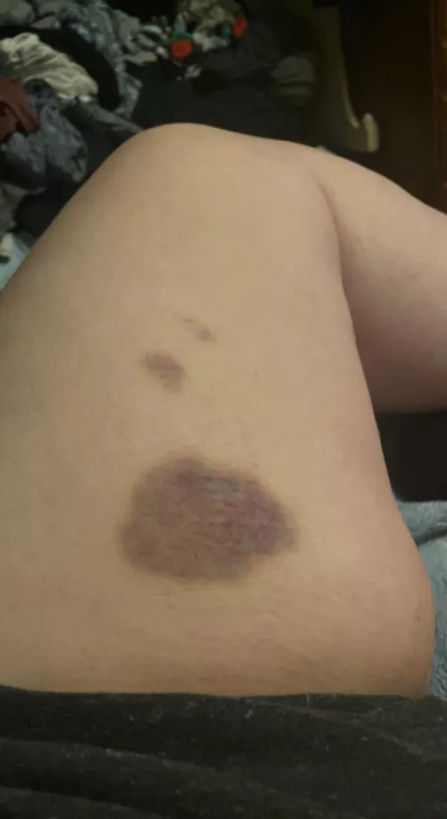 Had some impact play in the car on a road trip. My other leg was jealous