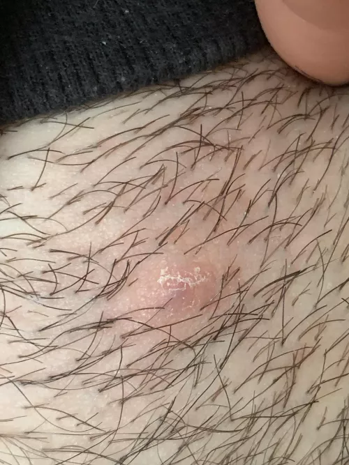 Please help is this an ingrown hair on my pubic area? I got some puss out of it!