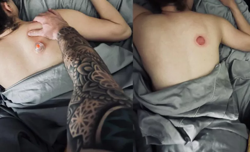 Experimenting with cupping. Did we do this right?