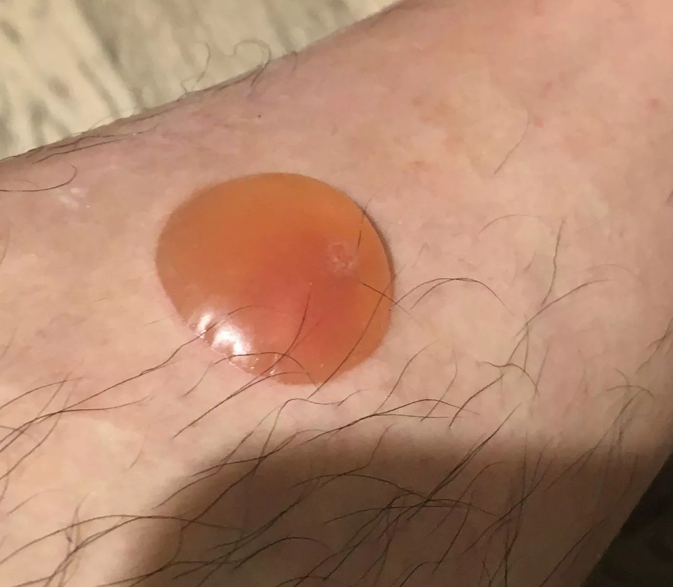 My mosquito bite. I am allergic and it looks worse than it actually is.