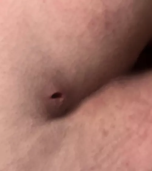 5 days after my pilonidal cyst draining