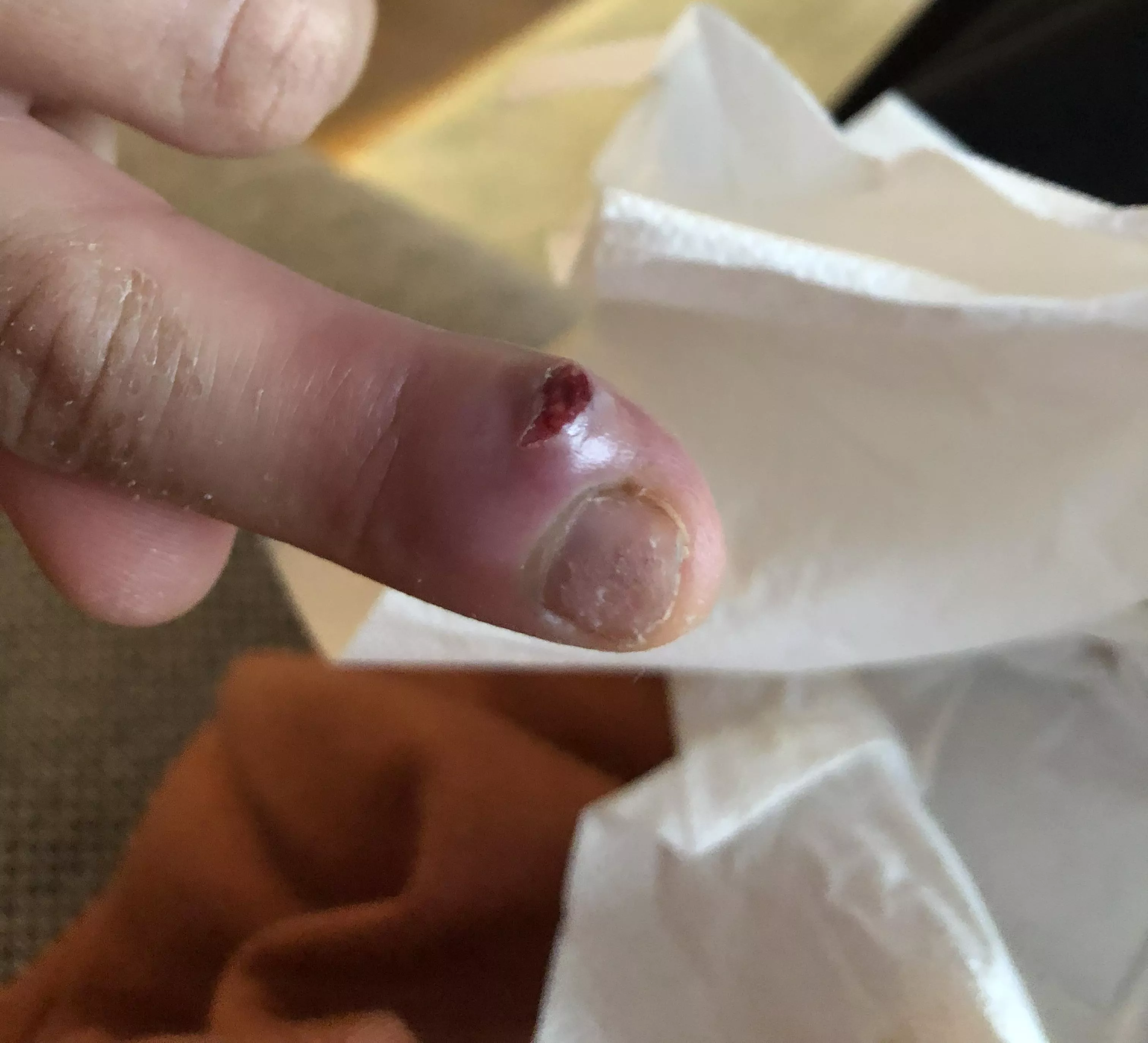 Infected finger popped overnight