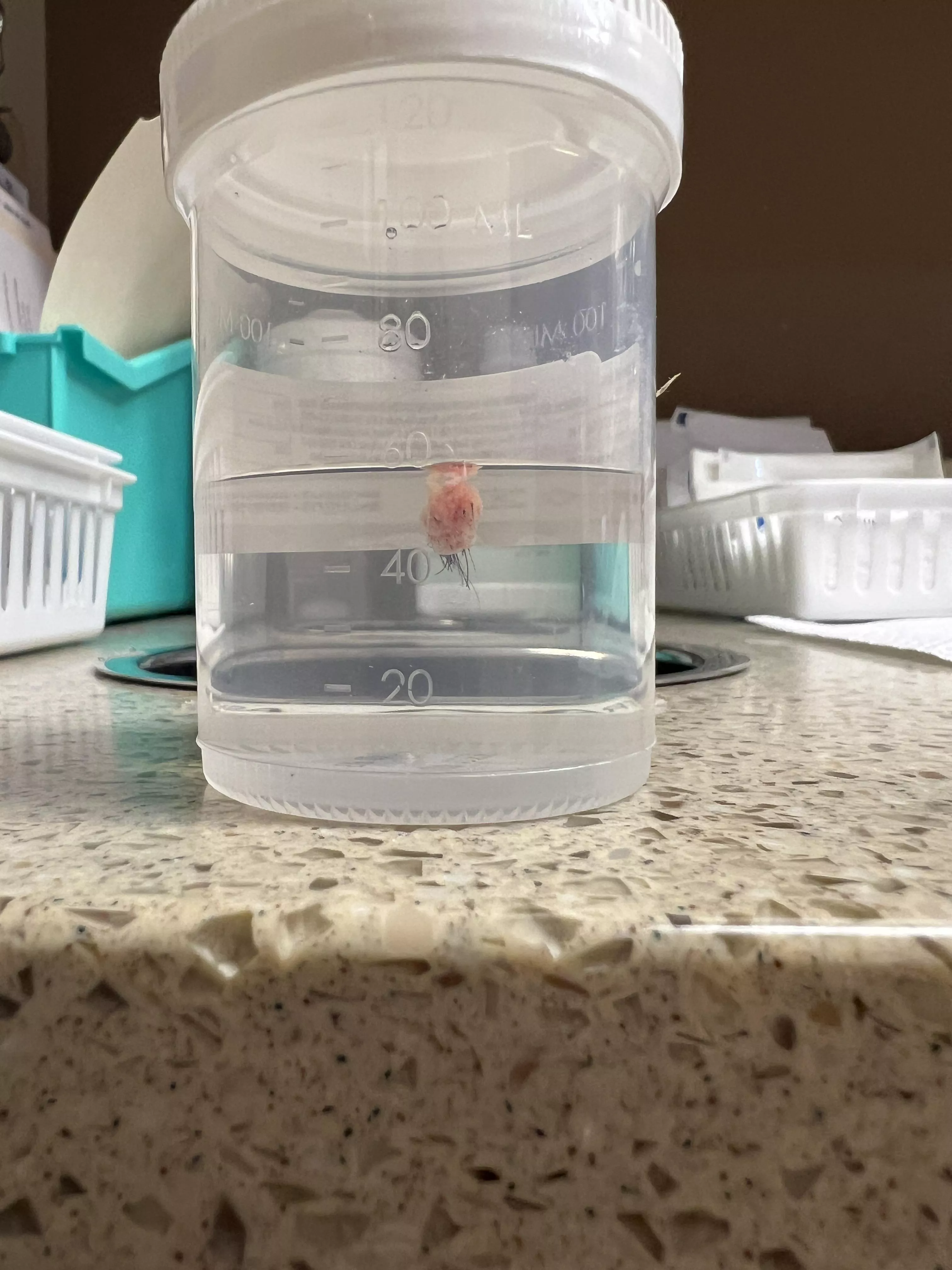 Just had this removed this morning.