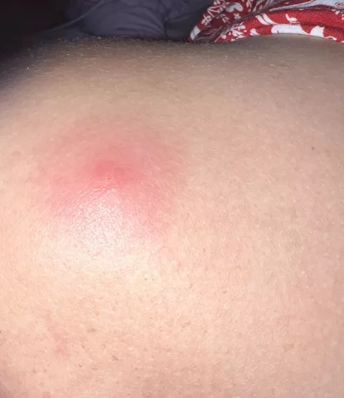 Painful pimple on shoulder?