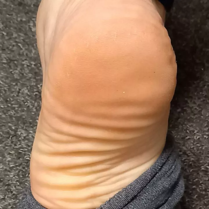 Wrinkles