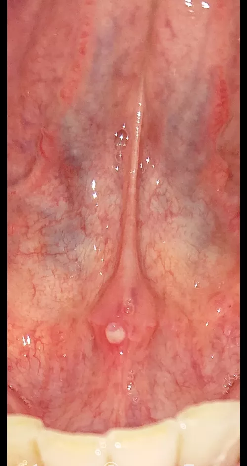 forbidden pop? (under tongue) two days ago i was at the dentist and the assistant got the saliva-vacuum stuck to it