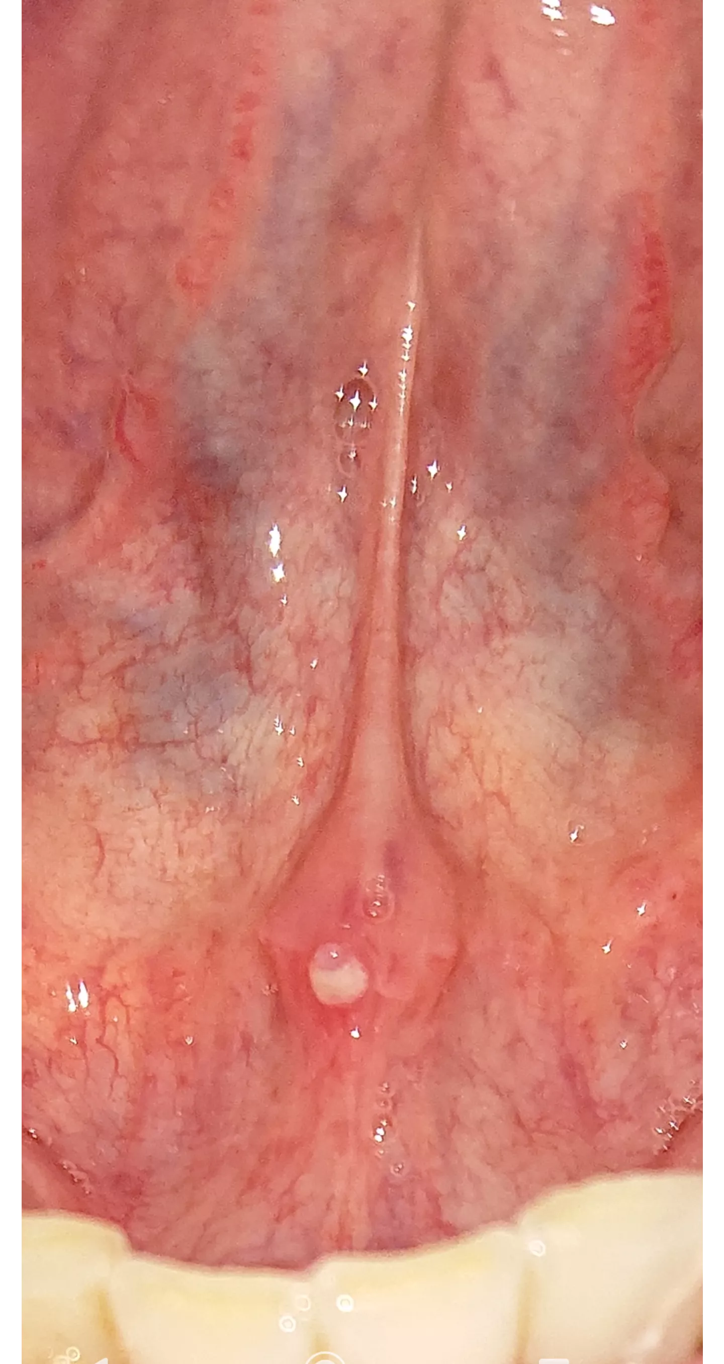 forbidden pop? (under tongue) two days ago i was at the dentist and the assistant got the saliva-vacuum stuck to it