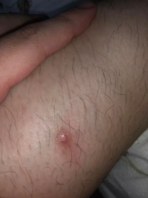 Is this a cyst or a wart?