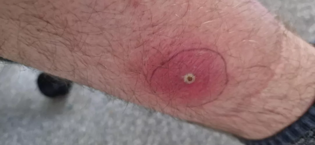 Forbidden Pop - maybe an insect bite?!
