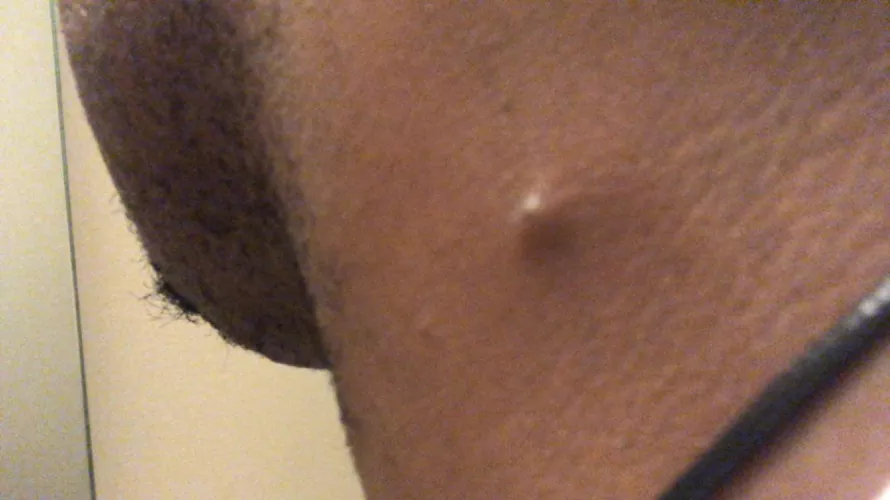 What is this, it’s hard and tender to the touch, it moves when I try to pop it