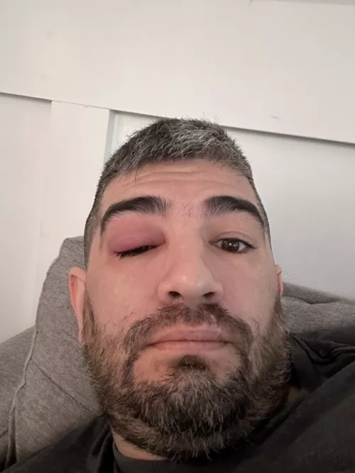 Forbidden pop, felt it starting on Monday