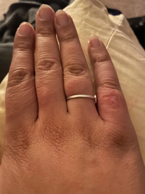 Noticed this little guy and he drained a lot of clear fluid and filled back up immediately