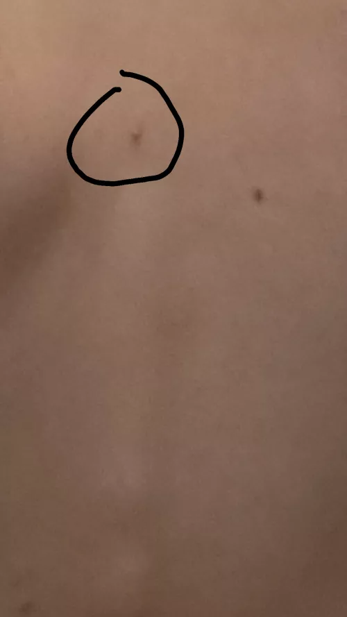 big white head on the muddle of my back sorry bad photo very hard to get a photo of it xD