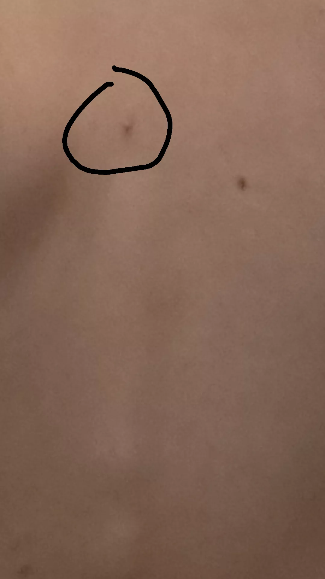 big white head on the muddle of my back sorry bad photo very hard to get a photo of it xD