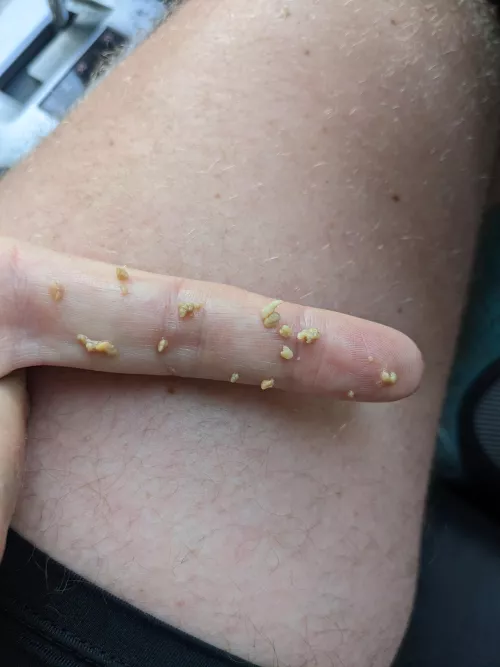 I felt a little something at the back of my throat while running. Got back in the car and managed to remove this all from my right tonsil.