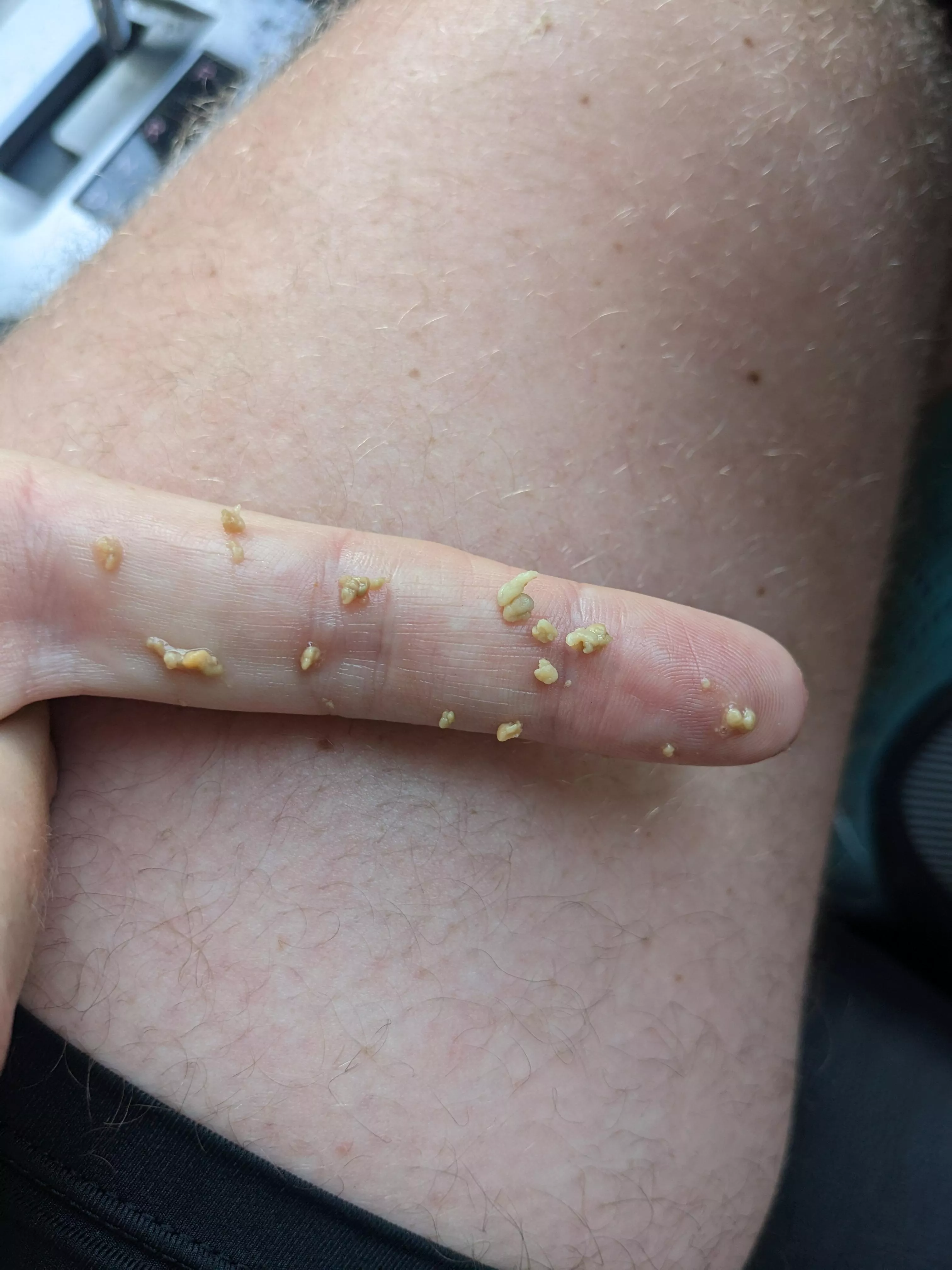 I felt a little something at the back of my throat while running. Got back in the car and managed to remove this all from my right tonsil.