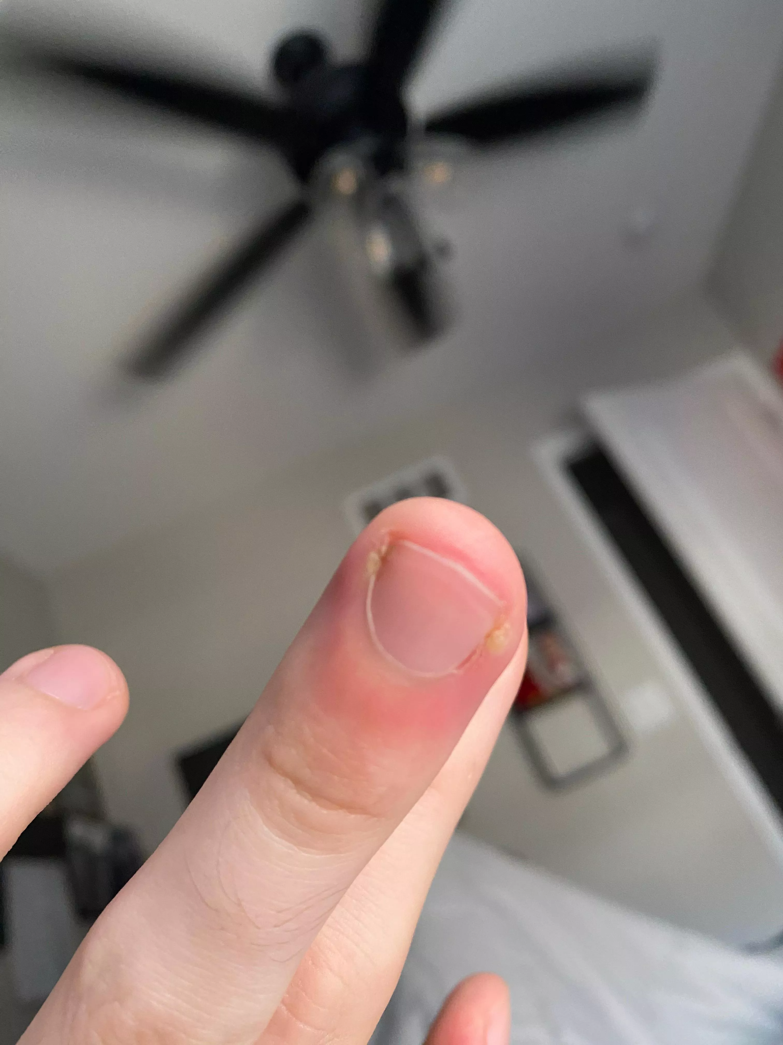 Mild looking paronychia, but hurts so bad. About to pop it. Will I need antibiotics?