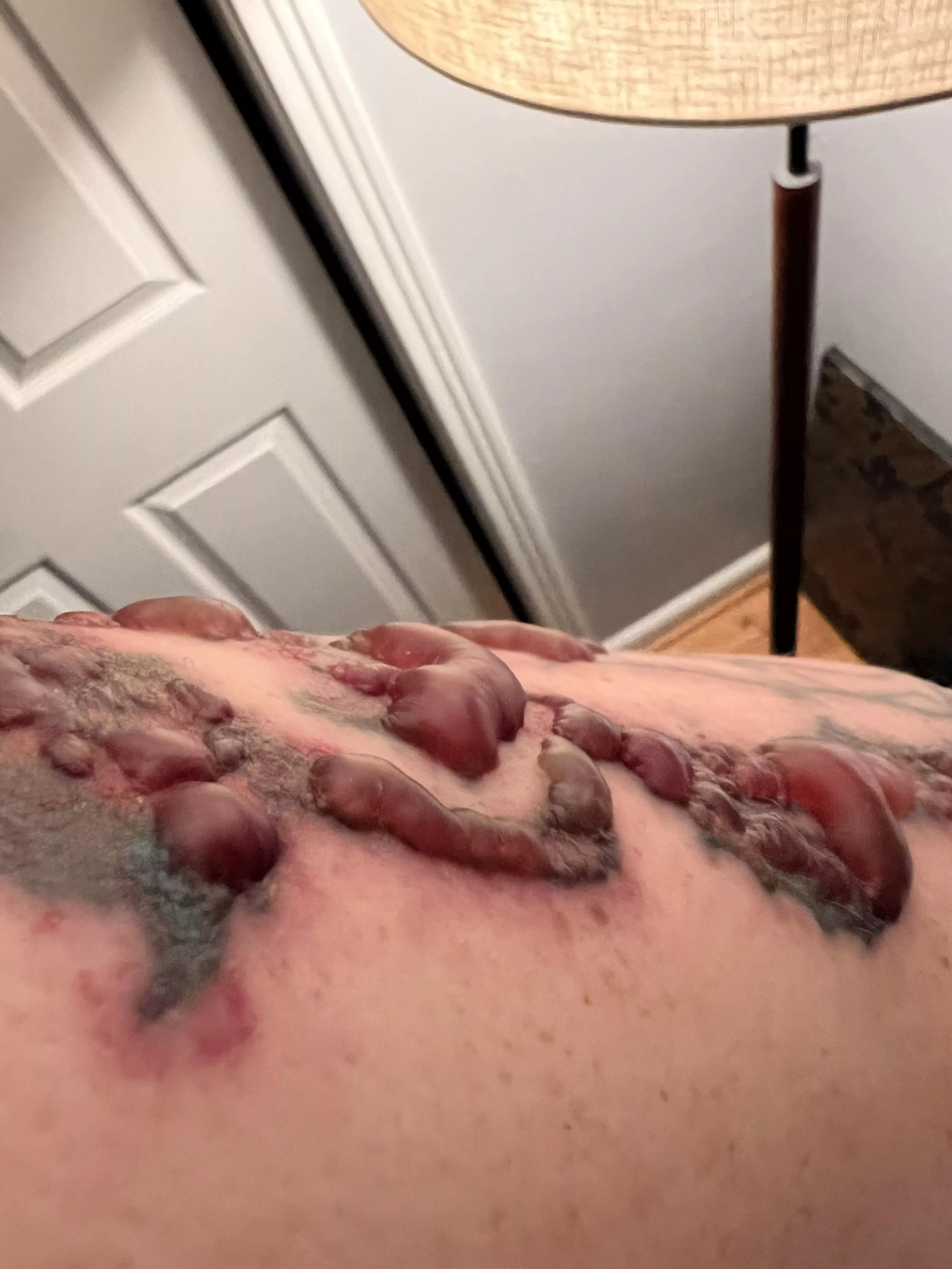 8 hours after a tattoo laser removal. Really want to go at this giant blisters.