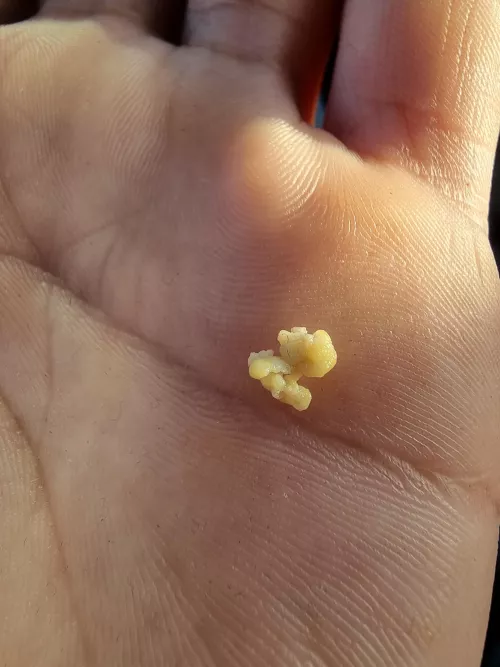 just hit my bong and coughed out this lump of shit, it smells like literall death and im only 21. could it be Bronchitis?