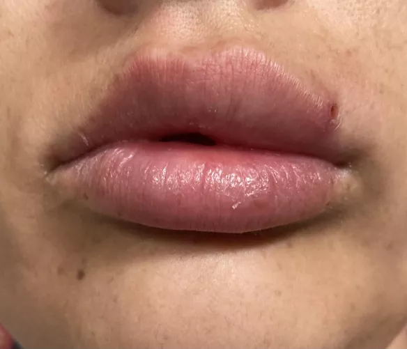 Two days ago I popped a small blackhead on my lip-line. My lip now looks like I have a filler injected on that side! Think I have a trip to the GP in my future