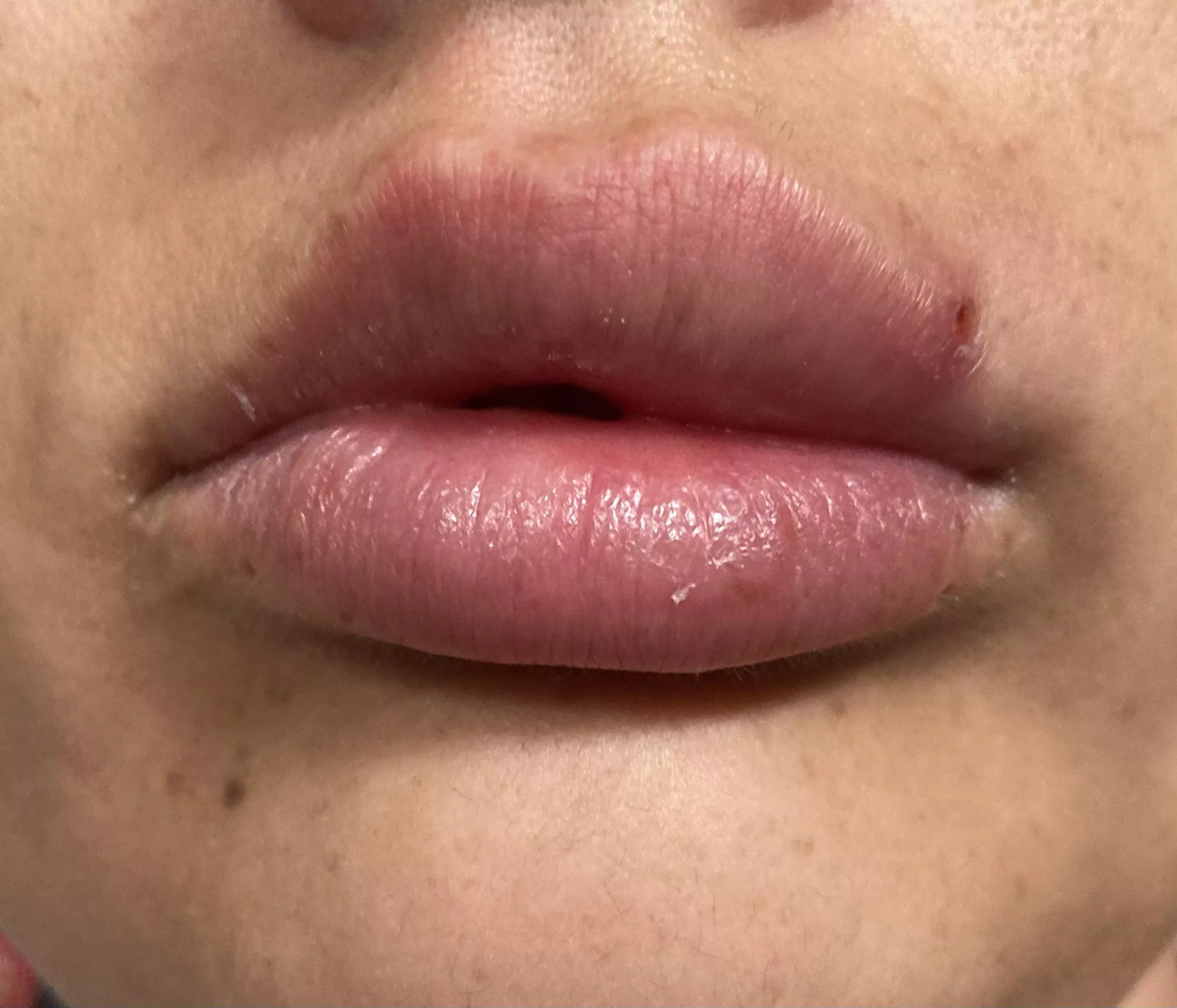 Two days ago I popped a small blackhead on my lip-line. My lip now looks like I have a filler injected on that side! Think I have a trip to the GP in my future