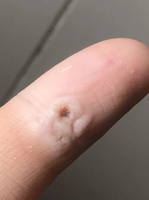 Used Apple Cider Vinegar on a wart for a few days and removed some using a nail clipper. Is it gone or should I keep going?