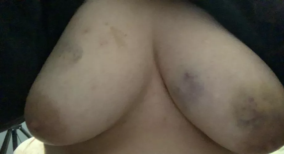 When Daddy gives me bruises I have heart eyes