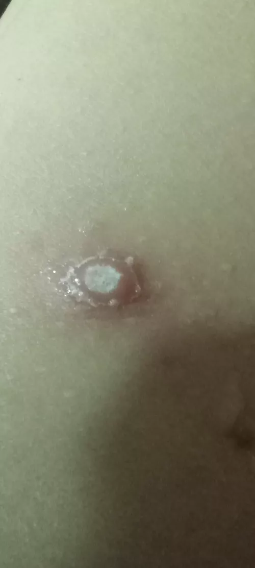 small wound starting to go yellow but very minimal popping. Been like this a few days, what kind of wound/infection is this?