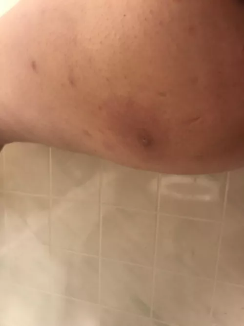 Well guys, I think I fucked up. This cyst popped under my skin and isn’t draining.