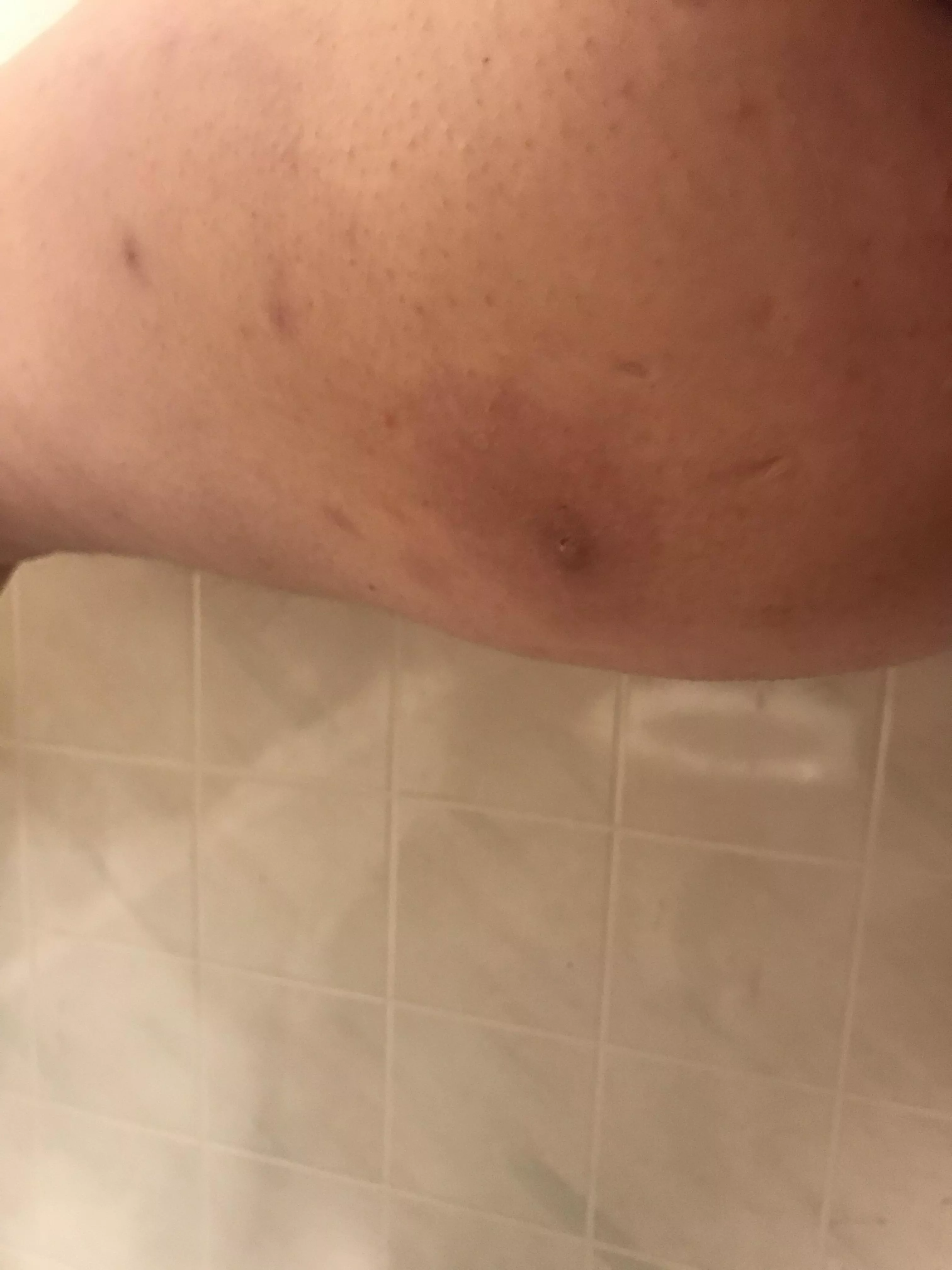 Well guys, I think I fucked up. This cyst popped under my skin and isn’t draining.
