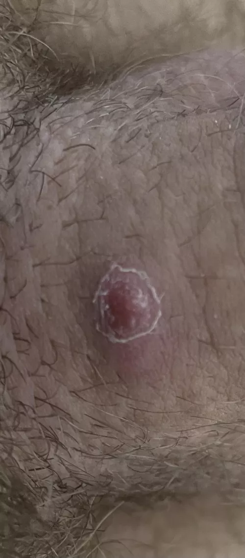 Bump on my shaft… Does This Look Like an Ingrown Hair?