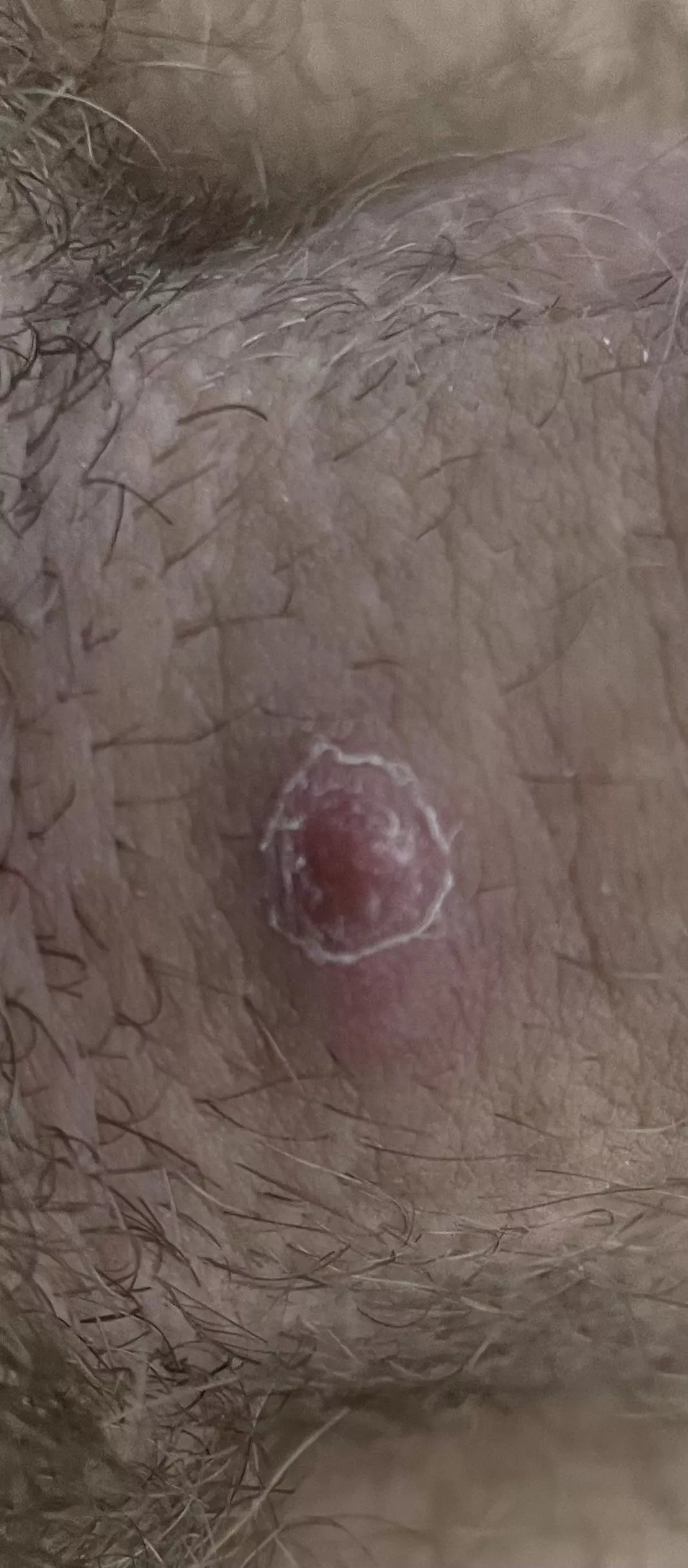 Bump on my shaft… Does This Look Like an Ingrown Hair?