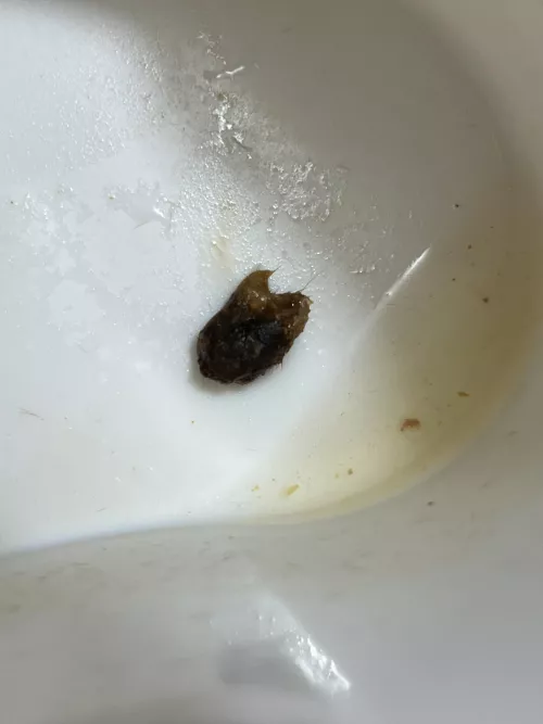 Chunk of impacted earwax I irrigated out of my ear!