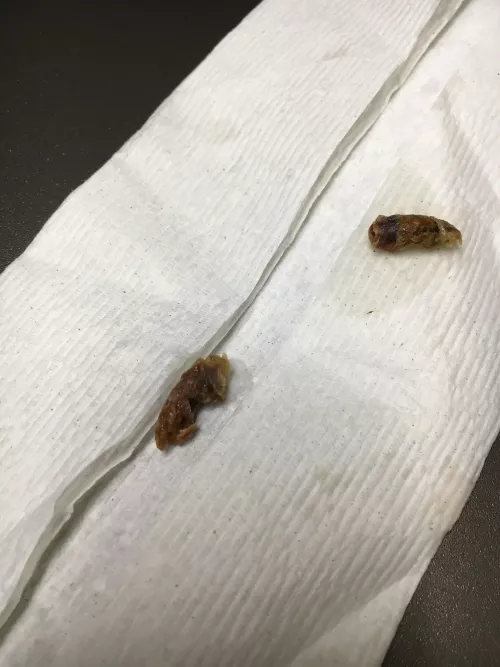 Doctor said some people just produce more earwax than others